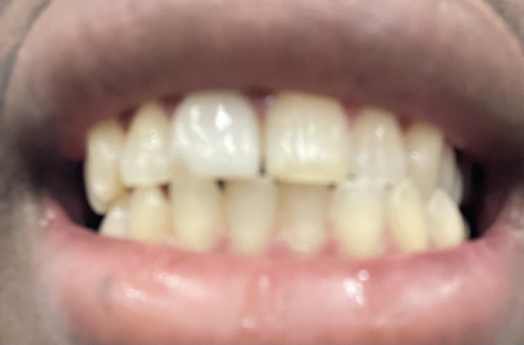 Opalescence Go 15% Mint - Prefilled Teeth Whitening Trays - 5194 customer photo 2