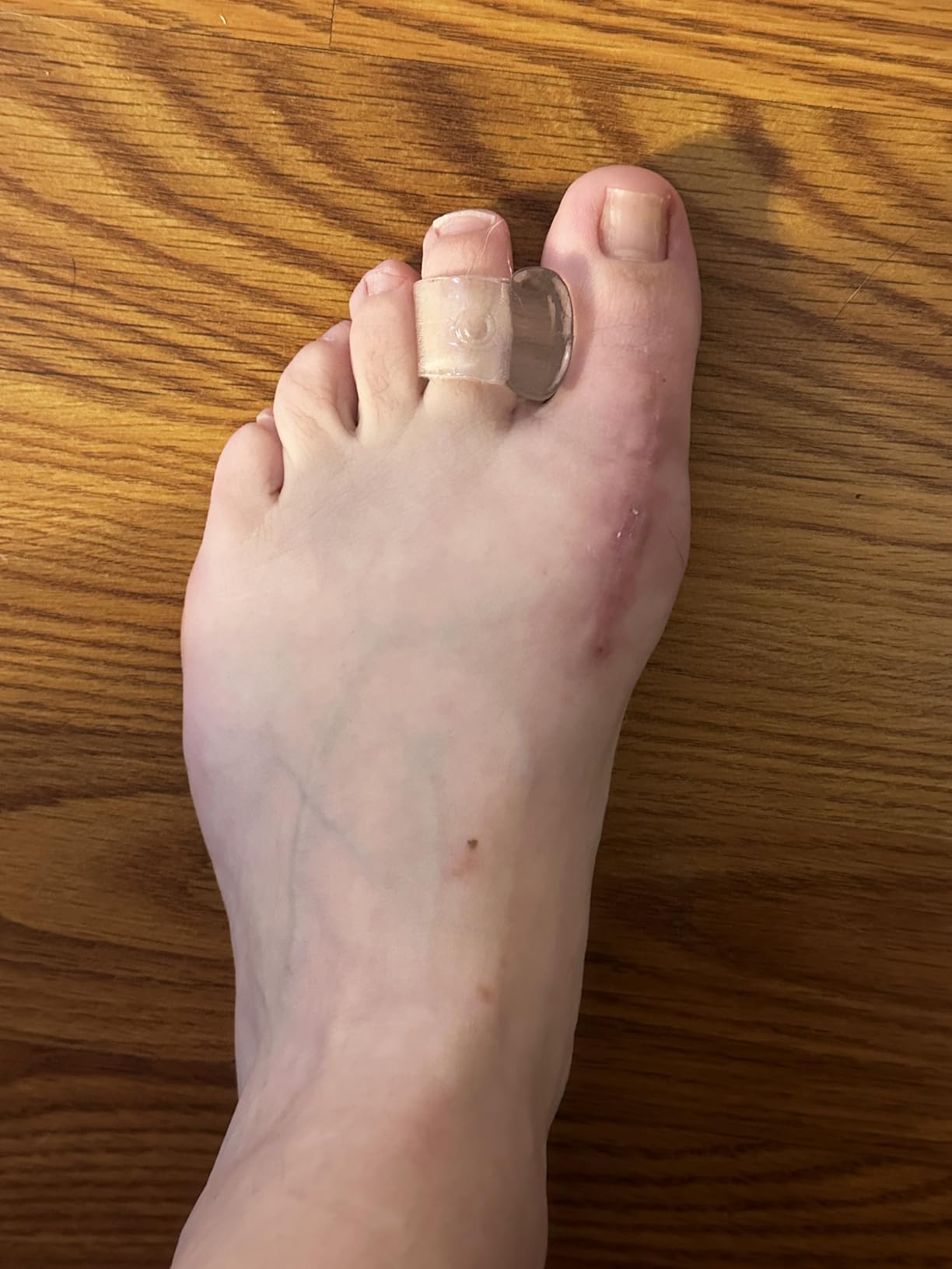 ZenToes Gel Toe Spacers for Bunions & Overlapping Toes, 4 Count customer photo 2