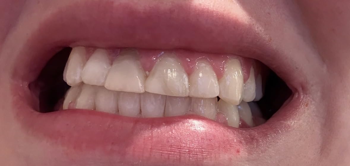 Crest Teeth Whitening Strips, Crest 3D Whitestrips Vivid Plus, Enamel Safe Teeth Whitening Kit, 12 Treatments (24 Strips), Visibly Whitens in Days, 8 Levels Whiter customer photo 2