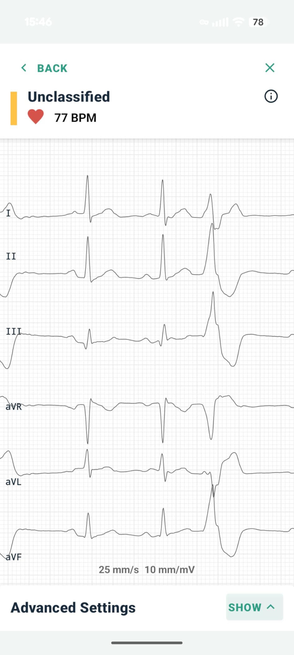 KardiaMobile 6L EKG, No Membership Required, Unlimited Recordings, HSA/FSA customer photo 2