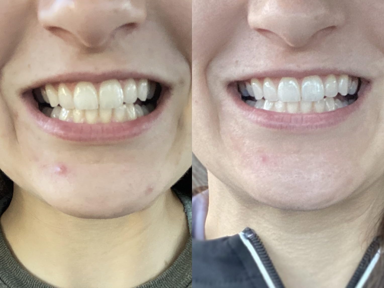 SmileDirectClub Teeth Whitening Kit with LED Light - 4 Pack Gel Pens - Professional Strength Hydrogen Peroxide customer photo 2