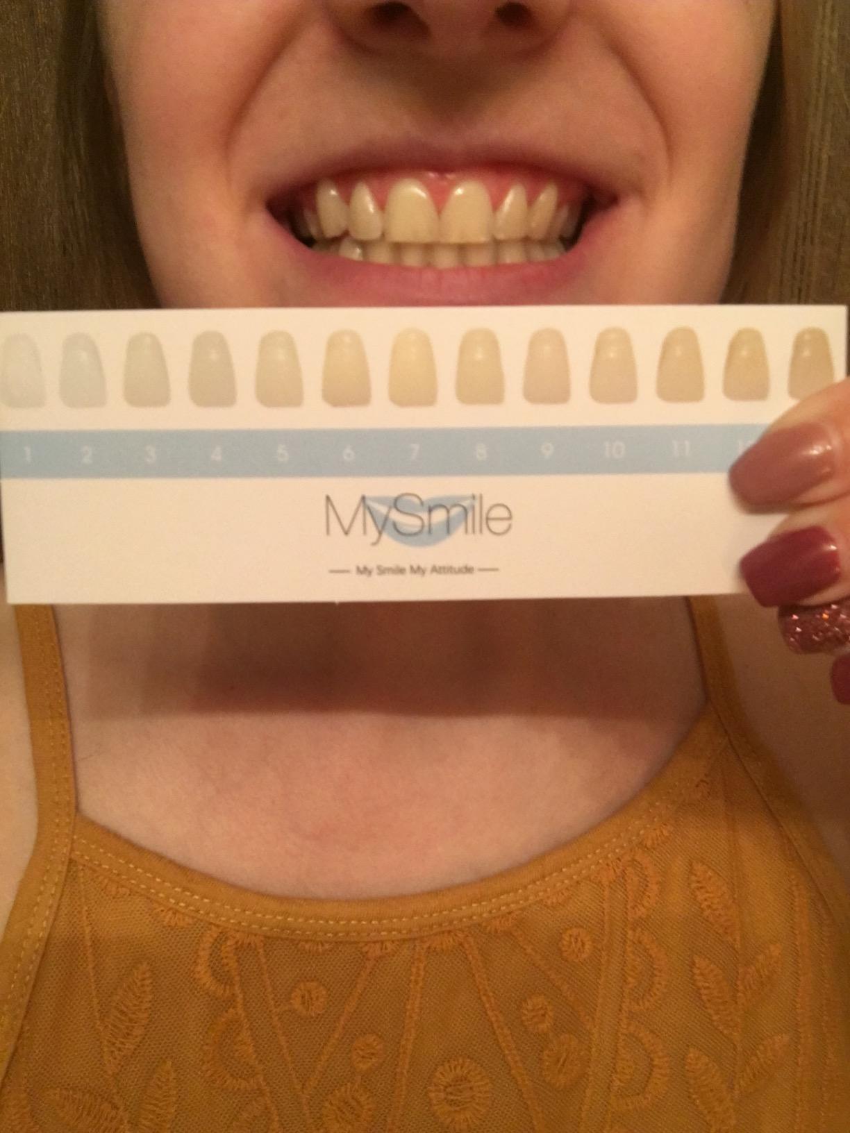 MySmile Teeth Whitening LED Light w/Mouth Tray Home Oral Whitening Device customer photo 2