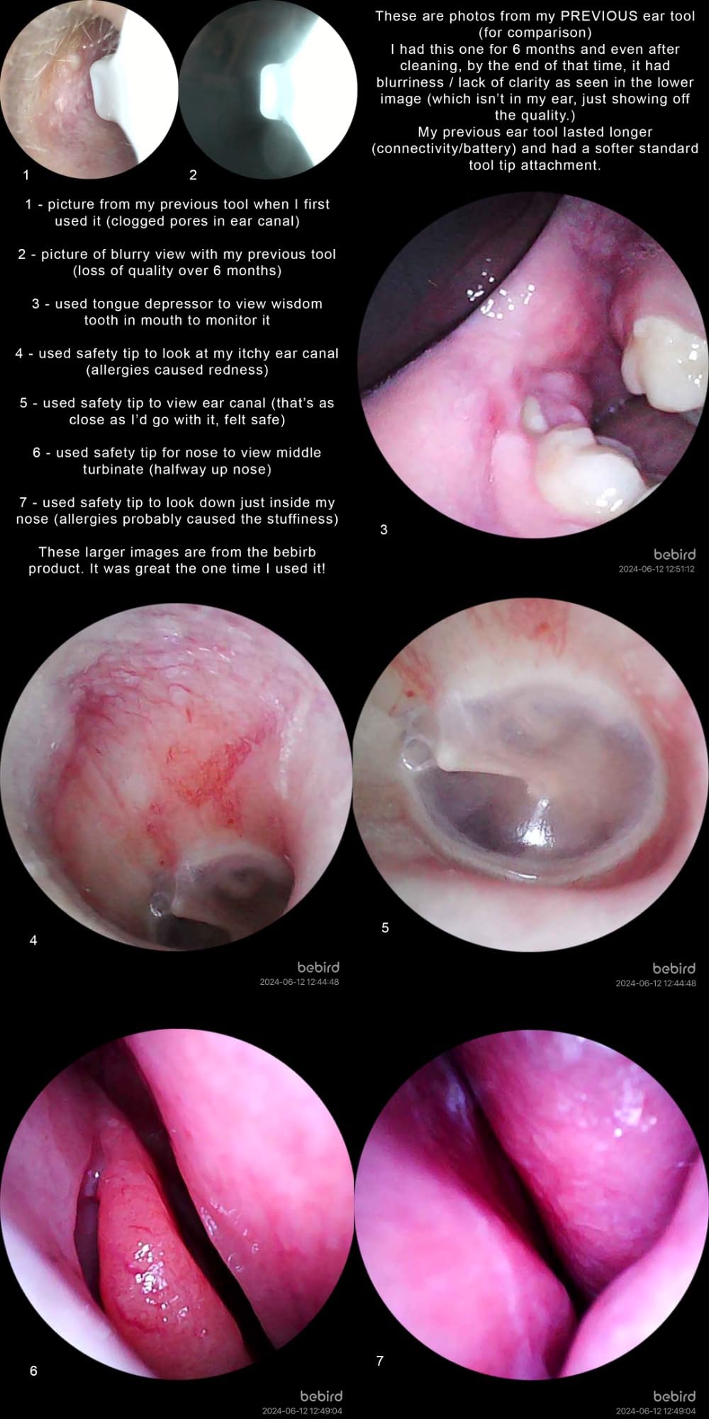 BEBIRD R1 Ear Wax Removal Tool:Ear Cleaner with HD Ear Camera FSA&HSA customer photo 1