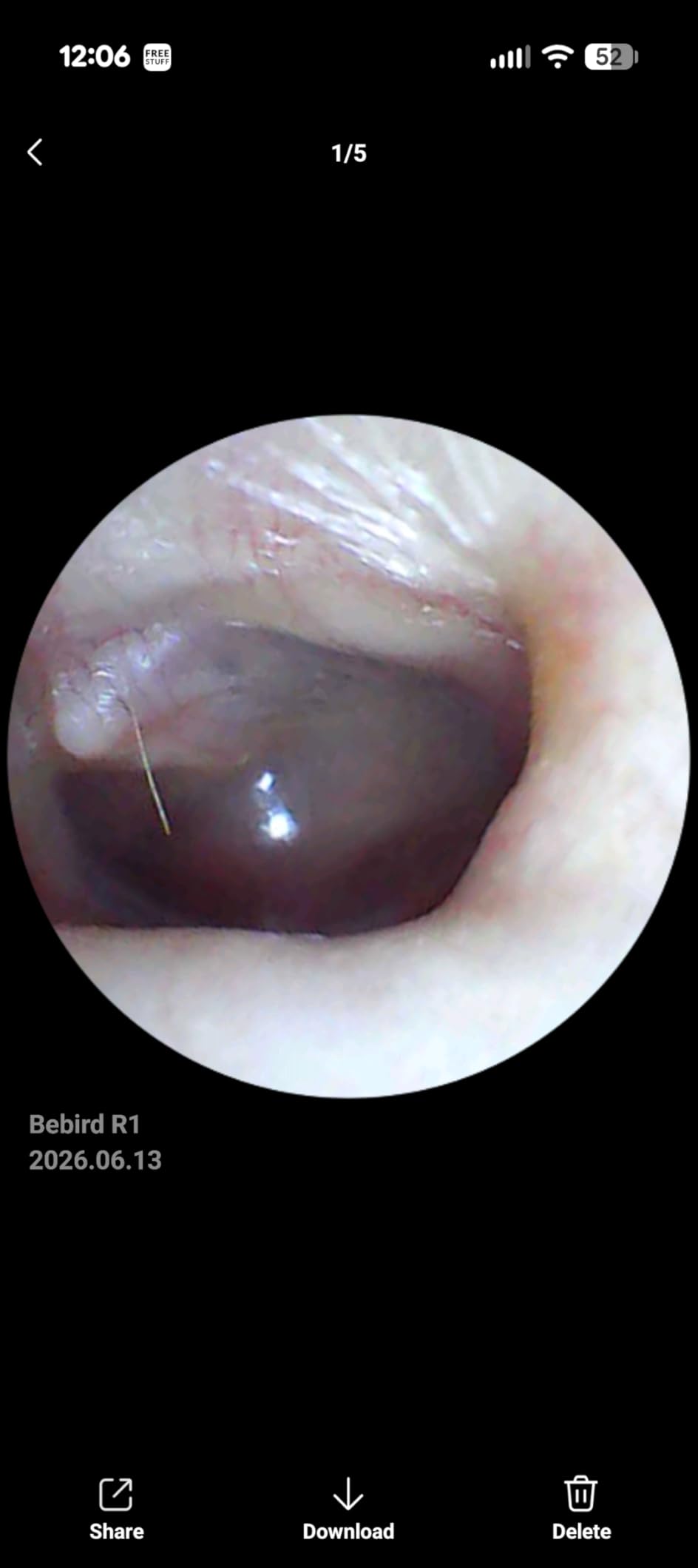 BEBIRD R1 Ear Wax Removal Tool:Ear Cleaner with HD Ear Camera FSA&HSA customer photo 2