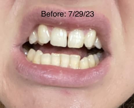 Pdoo Teeth Whitening Kit with LED Light for Sensitive Teeth, Fast Results for Brightening at Home, Teeth Whitening Gel Helps Remove All Kinds of Stains customer photo 2