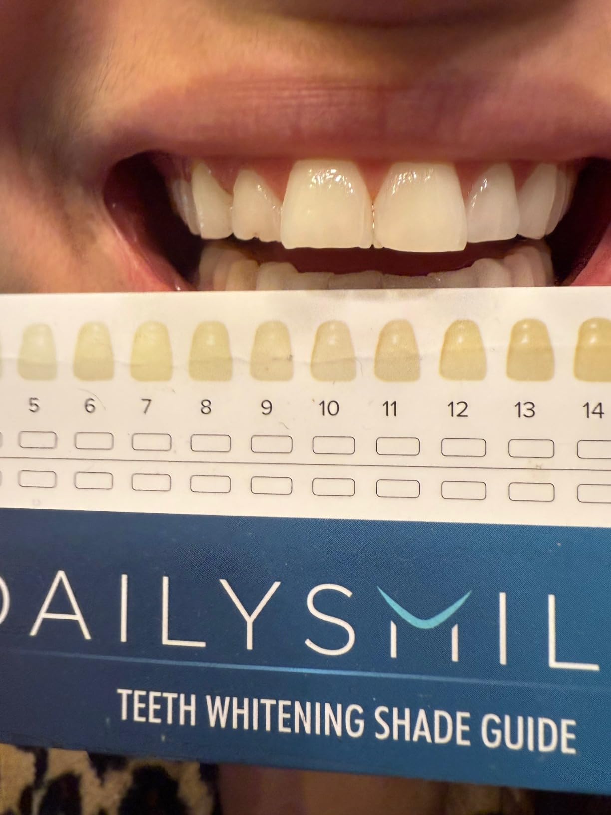 Teeth Whitening Kit with LED - Formulated for Sensitive Teeth, Hands-Free, Waterproof LED Light and 4 Gel Pens, Instant Results customer photo 1