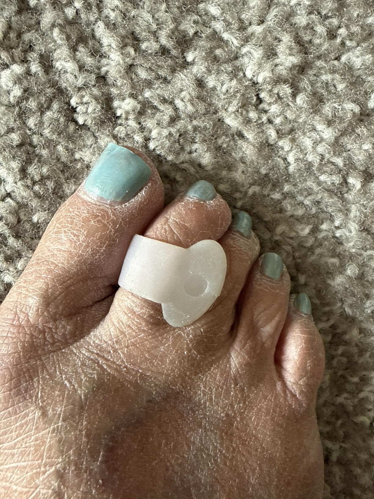 Welnove Gel Toe Separator, 12 Pack Pinky Toe Spacers, Aloe Vera Extract Infused Silicone Little Toe Spacers, Bunion Corrector, Bunion Cushions Pads for Preventing Rubbing & Relieve Pressure customer photo 1