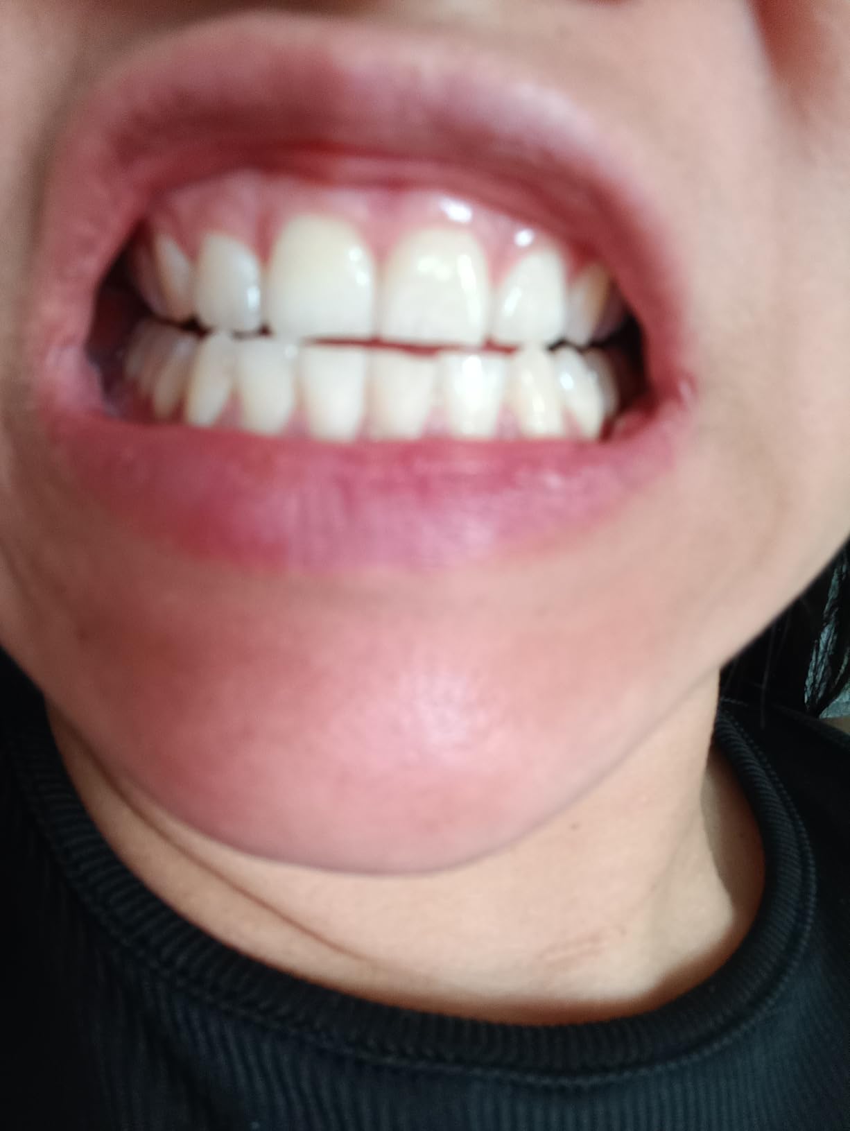 Teeth Whitening Kit for Sensitive Teeth,with 4 x 35% CP Pen & 1 Remineralization Pen,LED Accelerator Light Non,Tooth Whitener Professional Oral Care Gently Yet Effectively Removes Stains customer photo 1