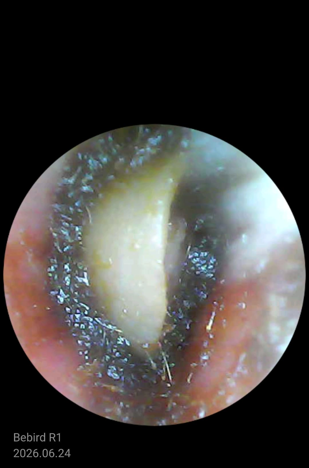 BEBIRD R1 Ultra Ear Wax Removal Tweezers: 1296P HD Ear Camera Cleaner IP67 customer photo 1